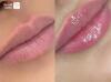 تزریق ژل و فیلر بادی + بوتاکس صورت و زیر بغل