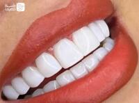 کامپوزیت،لمینت و بلیچینگ + جرم گیری دو فک