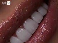 کامپوزیت،لمینت و بلیچینگ + جرم گیری دو فک