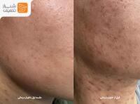جوانسازی پوست و صورت و درمان آسیب با خاویار تراپی