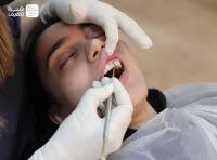 جرم گیری و بروساژ دندان