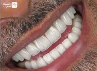 کامپوزیت،لمینت و بلیچینگ + جرم گیری دو فک