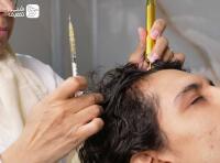 تزریق پی آر پی (prp)، کورتون و ژل اسید هیالورونیک برای زانو و کمر