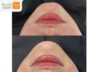تزریق فیلر تخصصی زیبایی