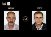 کاشت تخصصی مو، ابرو و ریش