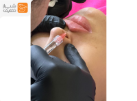 تزریق فیلر تخصصی زیبایی