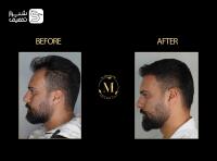 کاشت تخصصی مو، ابرو و ریش