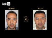 کاشت تخصصی مو، ابرو و ریش