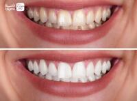 جرم گیری و بروساژ دندان 2 فک