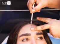 بوتاکس پارتی