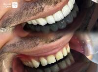 کامپوزیت با معتبرترین مواد روز دنیا (توکویوما، ips، سارمکو، kerr)