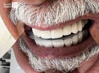 کامپوزیت با معتبرترین مواد روز دنیا (توکویوما، ips، سارمکو، kerr)