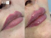 تزریق ژل و فیلر بادی + بوتاکس صورت و زیر بغل