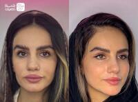 تزریق ژل و فیلر بادی + بوتاکس صورت و زیر بغل