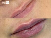 تزریق ژل و فیلر بادی + بوتاکس صورت و زیر بغل