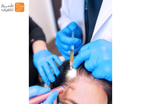 خدمات پی‌آرپی جوانساز صورت و درمانی برای ریزش مو