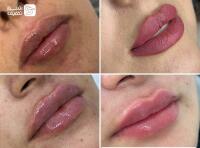 تزریق ژل و فیلر بادی + بوتاکس صورت و زیر بغل