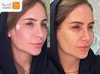 جوانسازی تخصصی با مزوتراپی