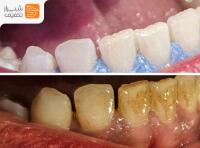 بلیچینگ تخصصی با مواد آمریکایی، آلمانی و برزیلی