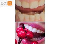 بلیچینگ تخصصی با مواد آمریکایی، آلمانی و برزیلی