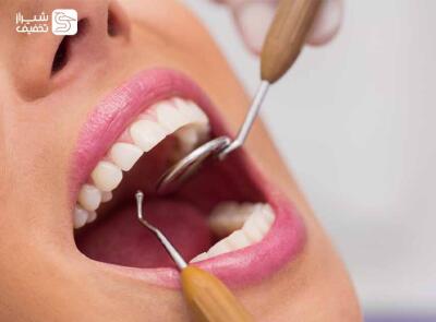 تخفیف ویژه برای جرمگیری و بیلیچینگ دندان در خانه و مطب در شیراز