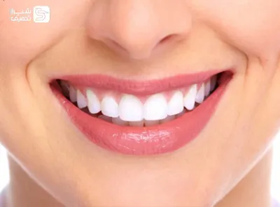 زیبایی و سفیدی دندان با بلیچینگ