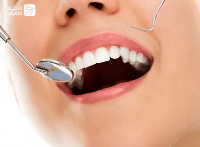 پر کردن دندان یک سطحی با کامپوزیت
