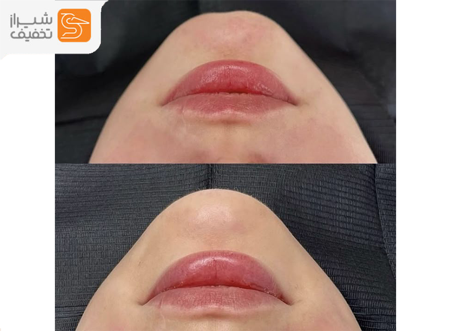 تزریق فیلر تخصصی زیبایی