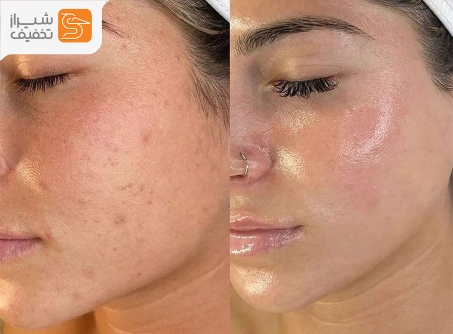 جوانسازی پوست با بهترین مزو‌ژل های تخصصی