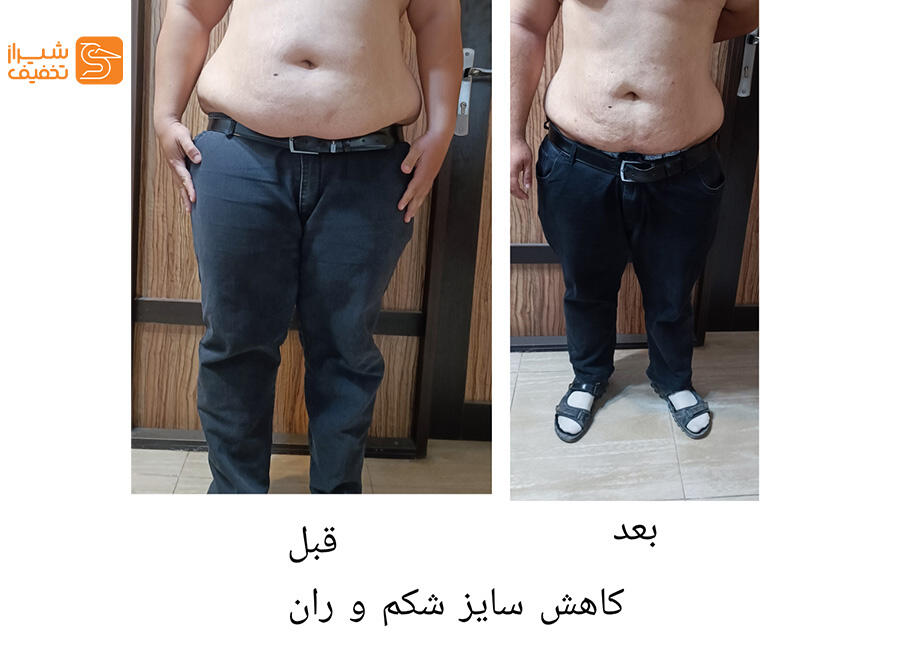لاغری موضعی با دستگاه RF، کویتیشن و کرایولیپولیز